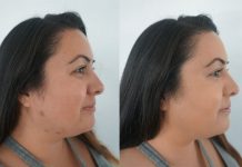 How to Cover a Scab With Makeup